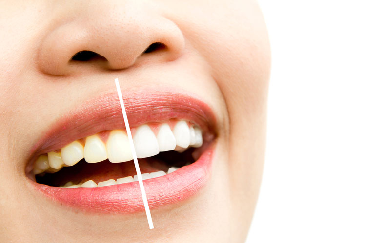 5 maneiras eficazes de clarear os dentes em casa