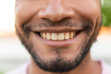 Yellow Teeth: Natural Shade or Sign of a Problem?