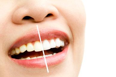 Λεύκανση δοντιών στο σπίτι: 5 αποτελεσματικοί τρόποι