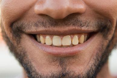 Gula tänder: är det normalt eller inte?