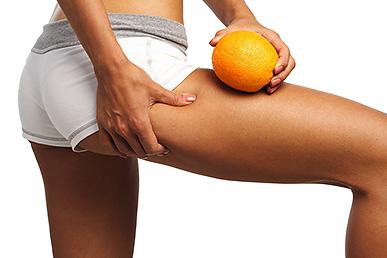 Misconceptions about cellulite