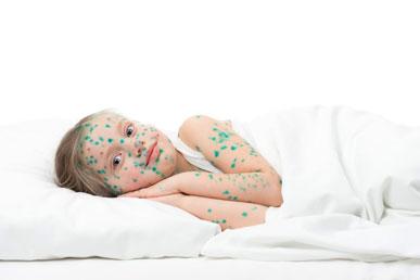 Is "Zelyonka" a cure for "chickenpox"?